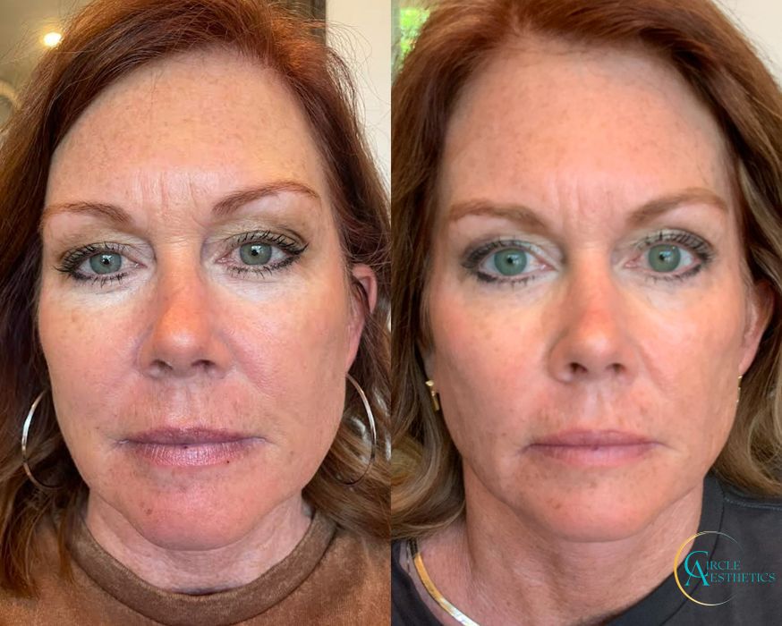 Skin Tightening - Case 16673