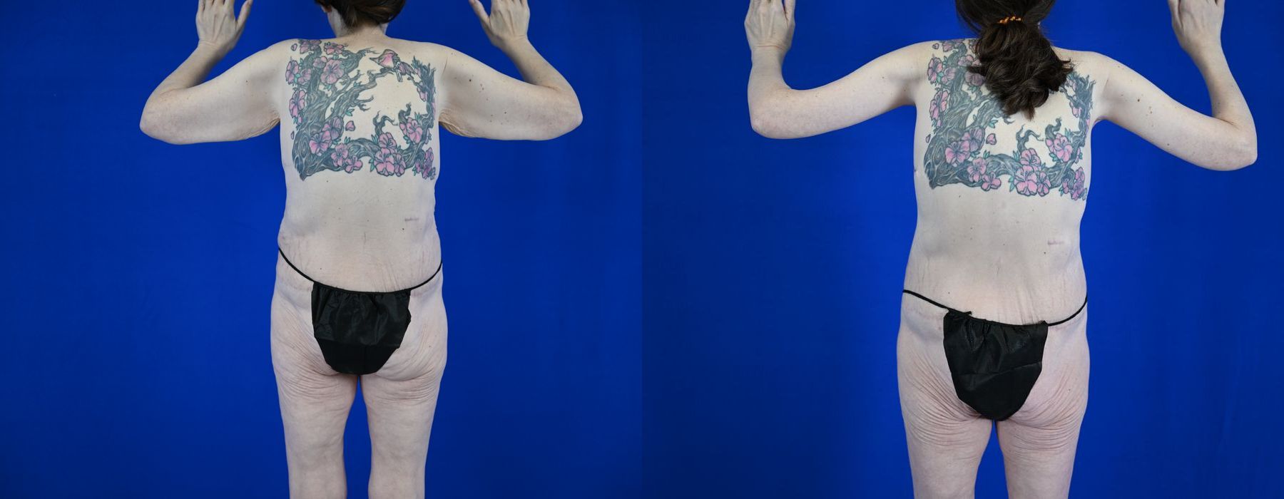 Breast Lift - Thumbnail 4