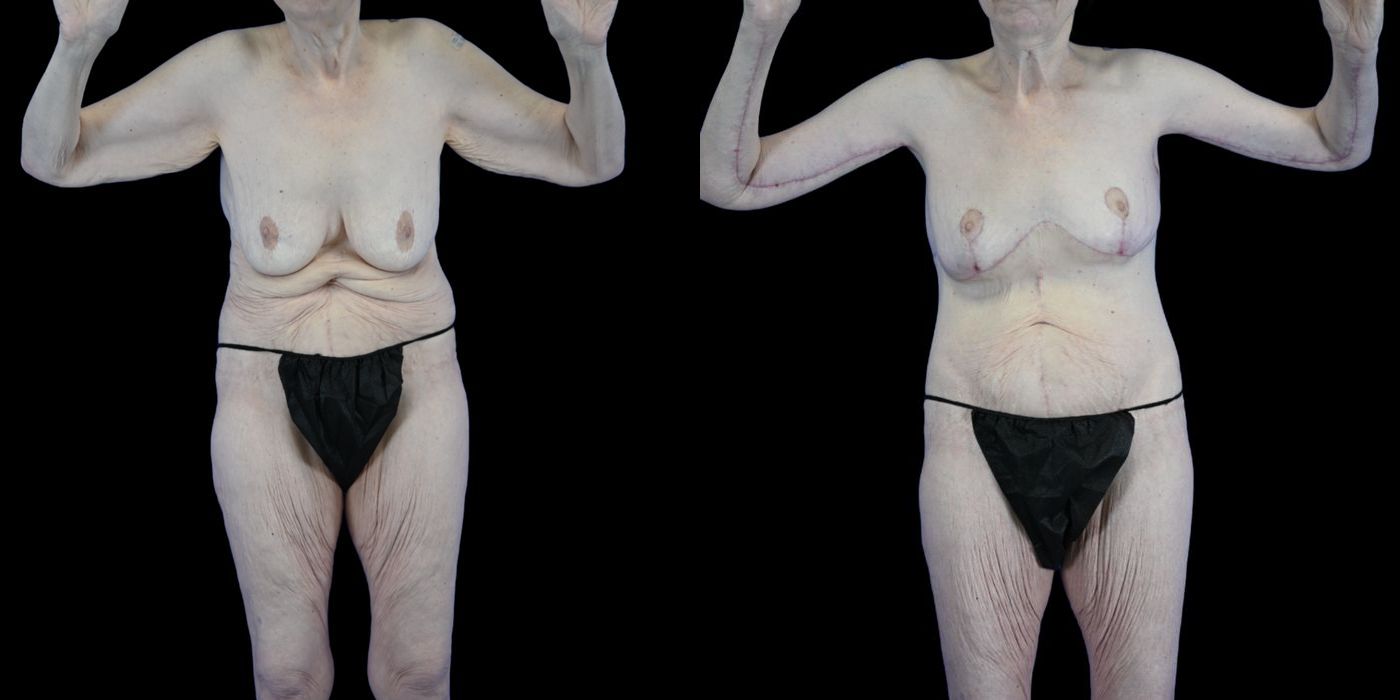 Before and after Body Lift case 26083