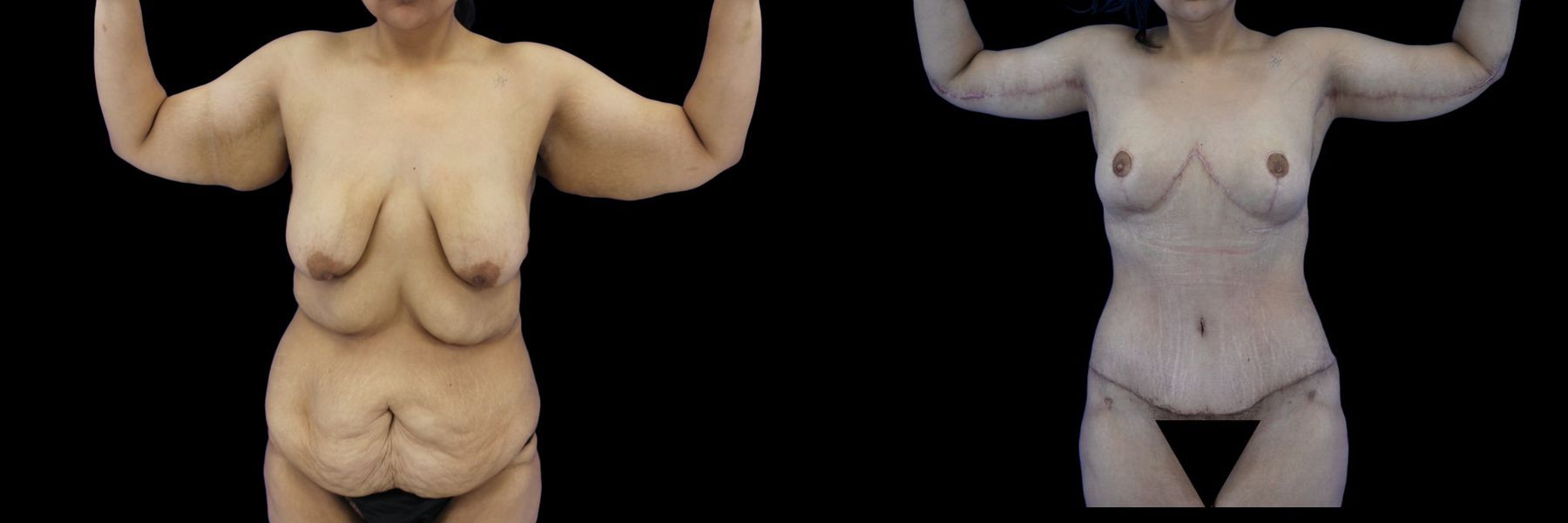 Before and after Body Lift case 26080 - Angle 5