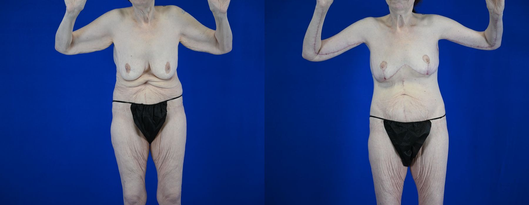 Breast Lift - Case 22960