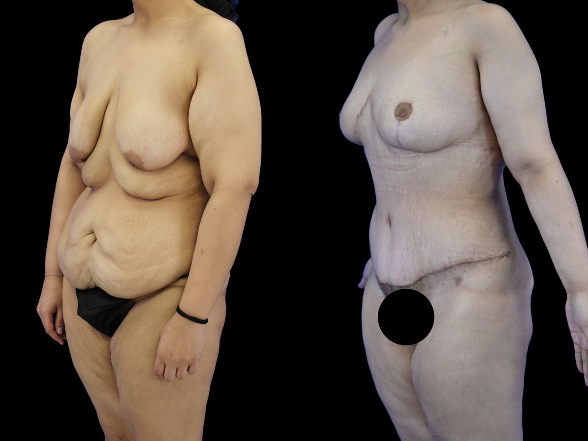 Before and after Body Lift case 26080 - Angle 2