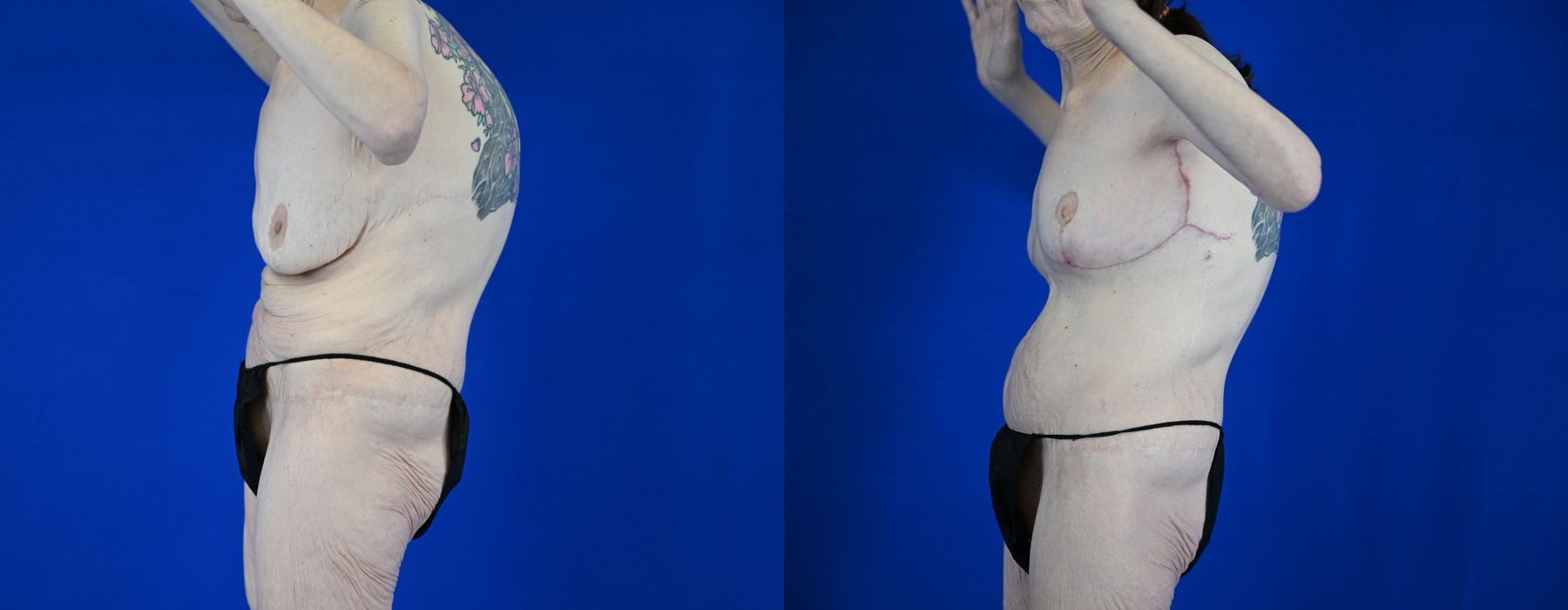 Breast Lift - Thumbnail 2