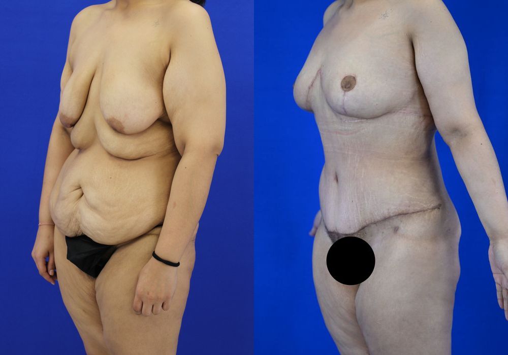 Tummy Tuck - Thumbnail 2