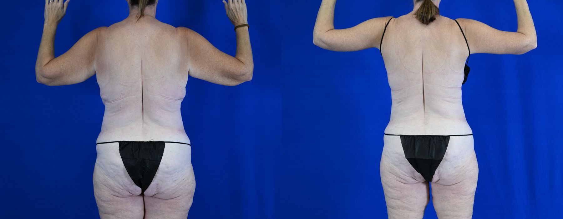 Breast Lift - Thumbnail 4