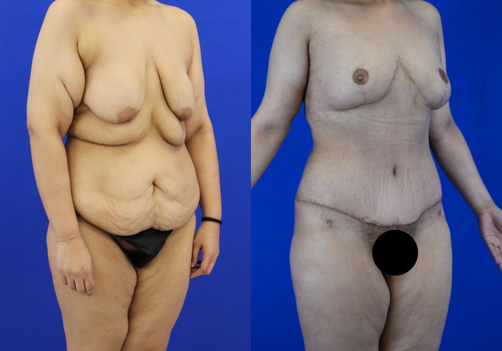 Tummy Tuck - Thumbnail 3