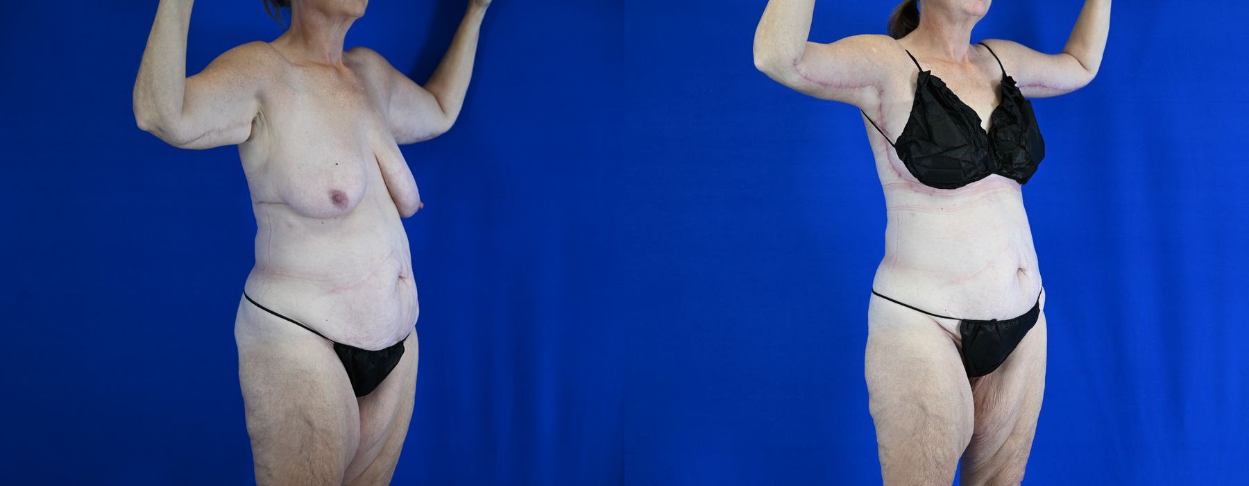 Breast Lift - Thumbnail 3