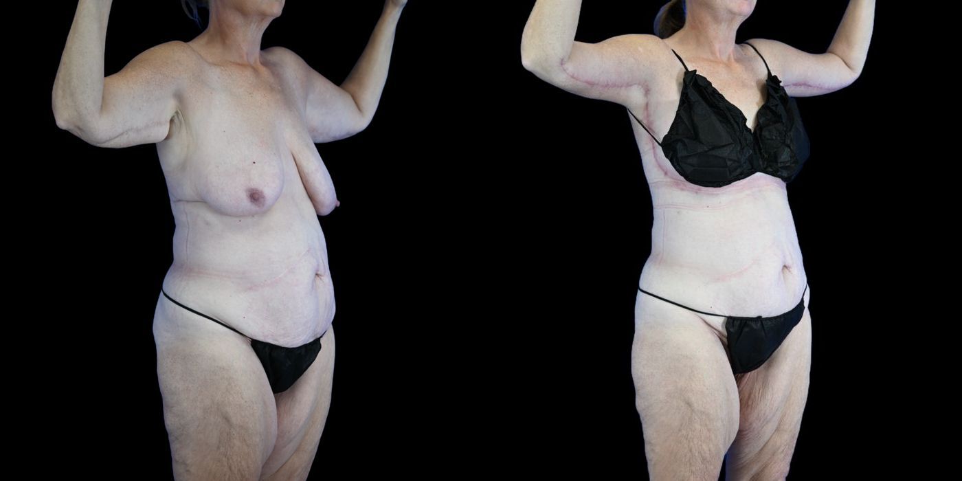 Before and after Body Lift case 26085 - Angle 3