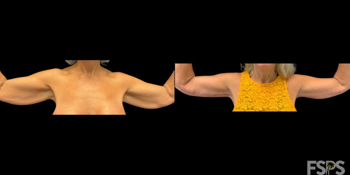 Arm Lift - Case 22732