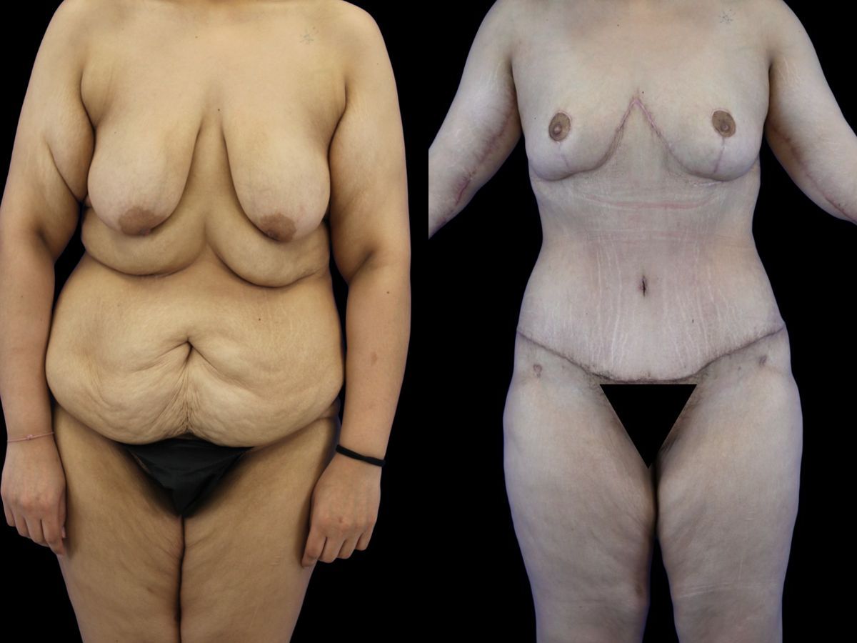 Before and after Body Lift case 26080