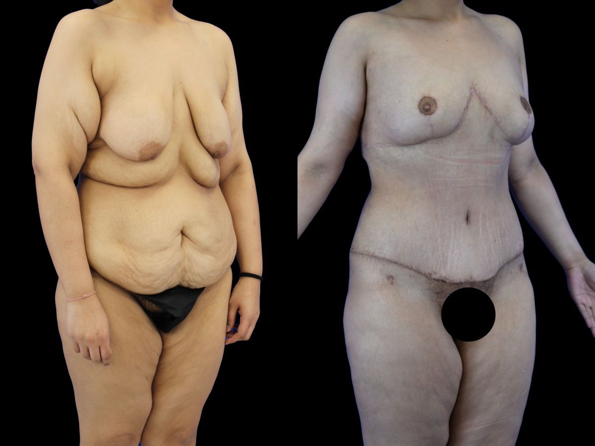 Before and after Body Lift case 26080 - Angle 3