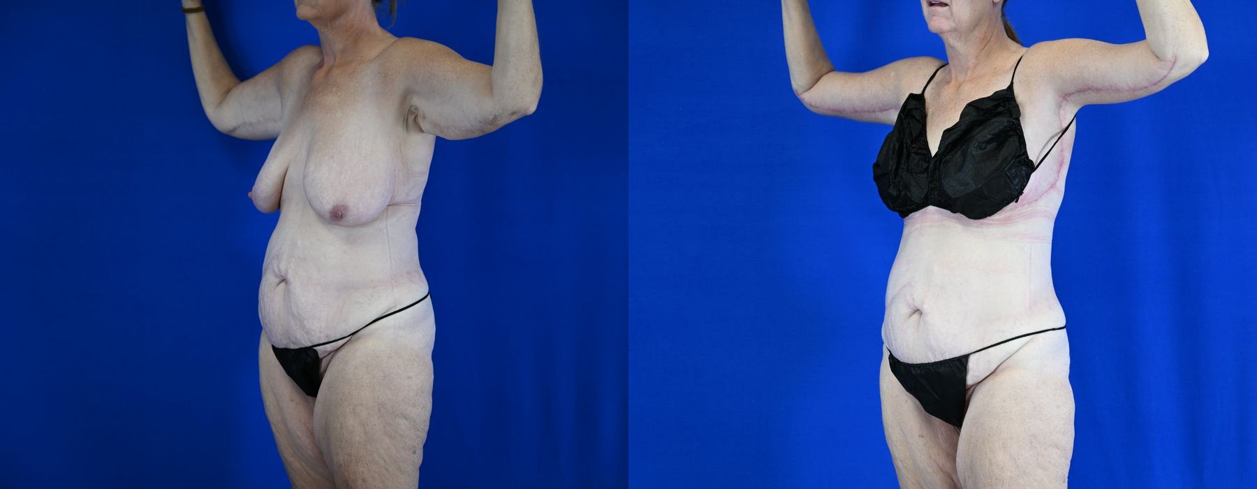 Breast Lift - Thumbnail 2