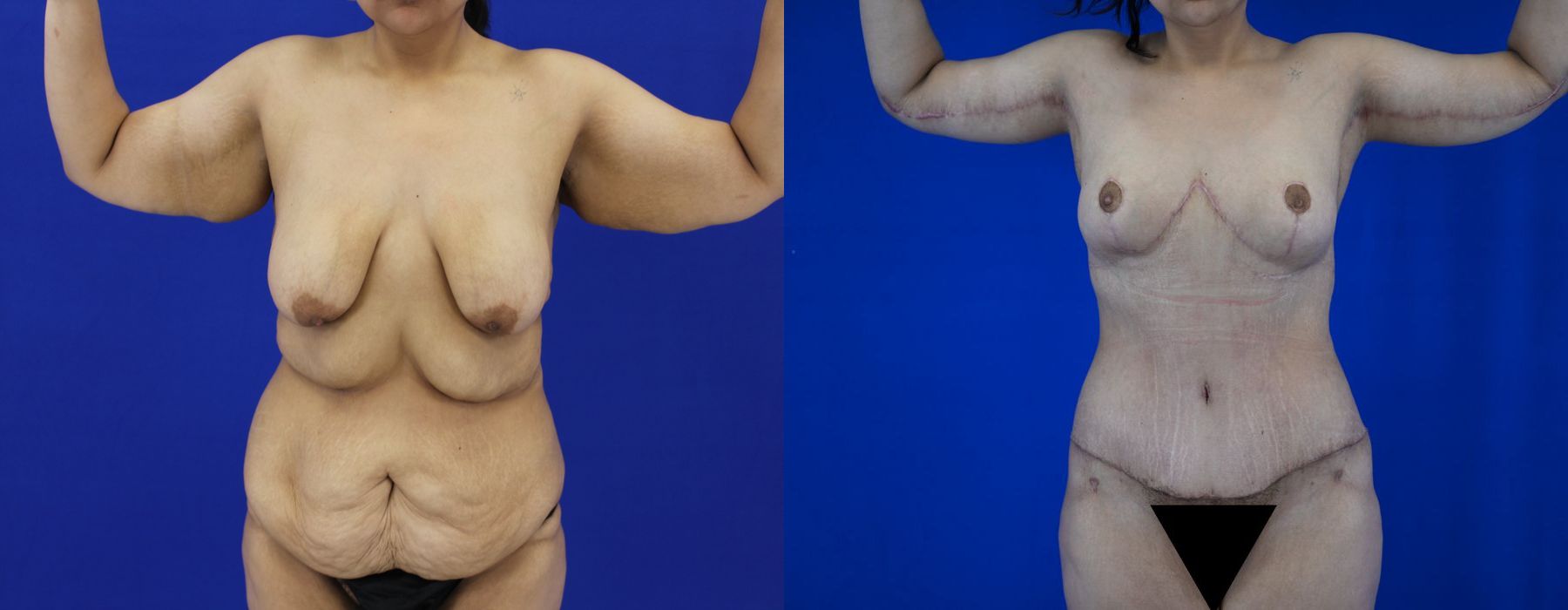 Tummy Tuck - Thumbnail 5