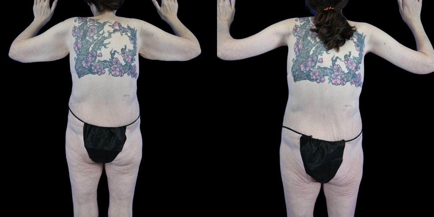 Before and after Body Lift case 26083 - Angle 4