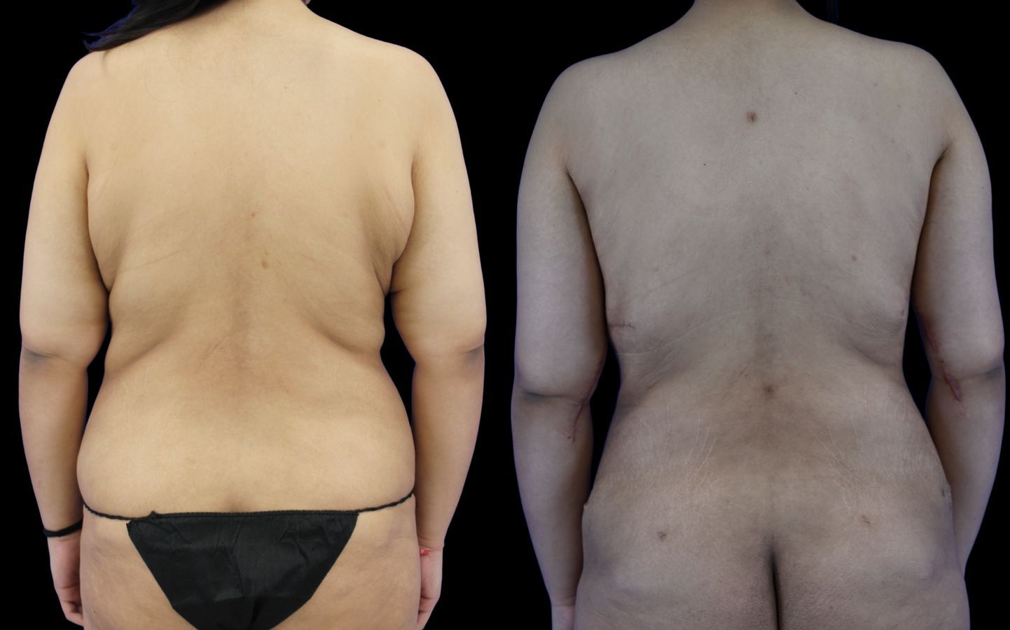Before and after Body Lift case 26080 - Angle 4