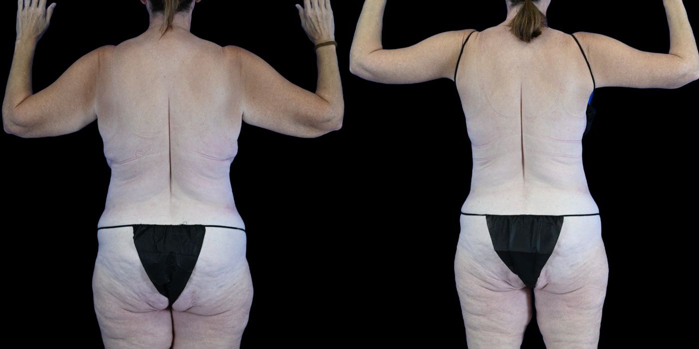 Before and after Body Lift case 26085 - Angle 4