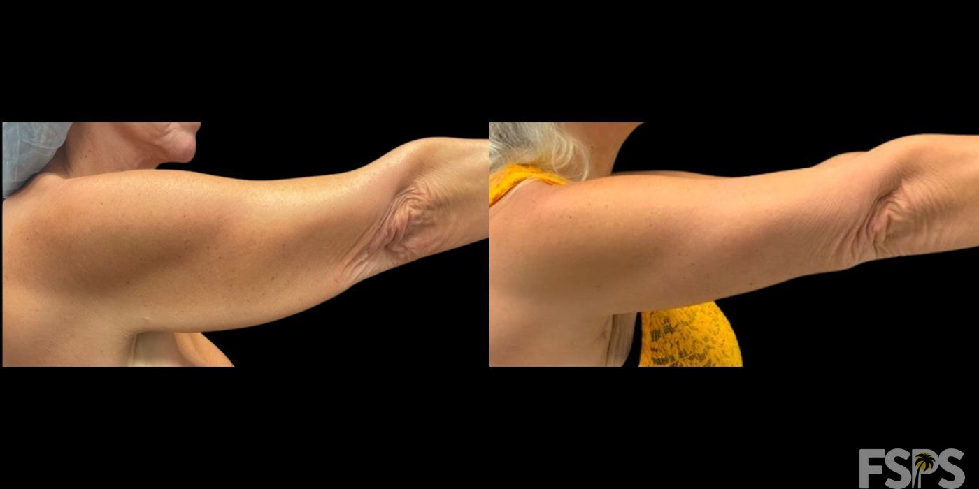 Arm Lift - Thumbnail 2