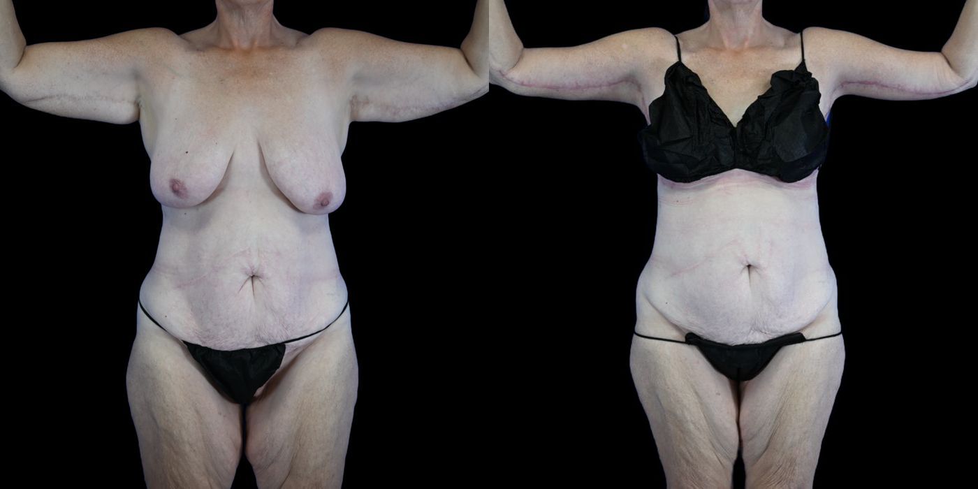 Before and after Body Lift case 26085