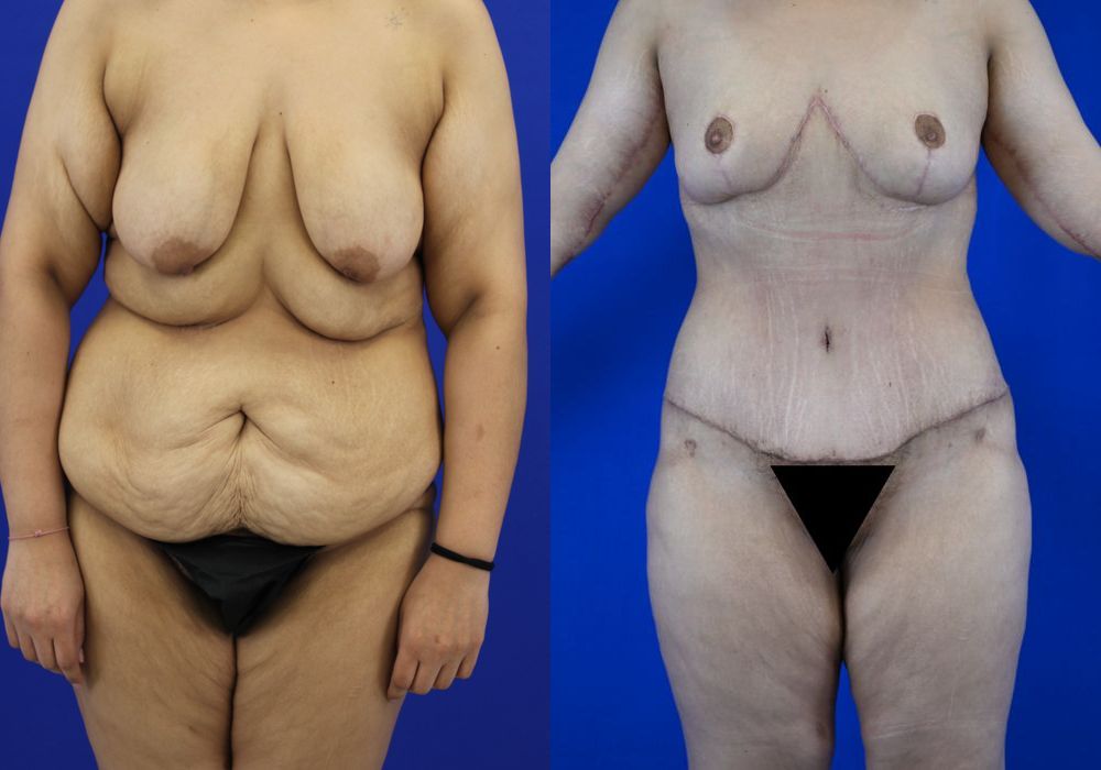 Tummy Tuck - Case 22932