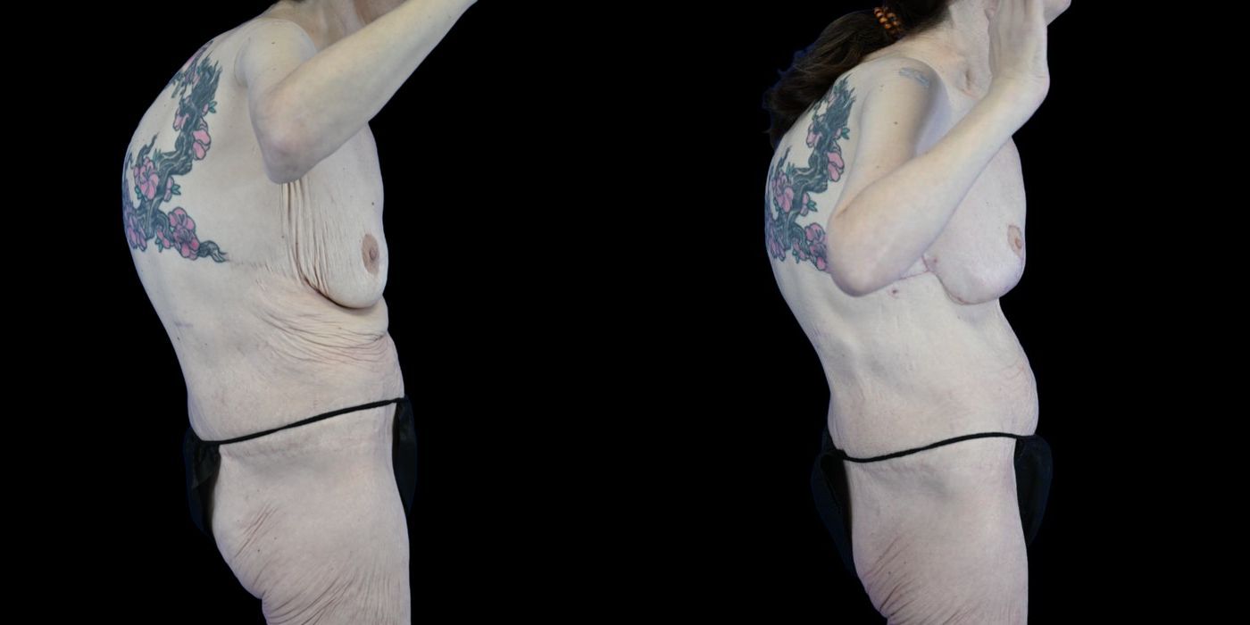 Before and after Body Lift case 26083 - Angle 3