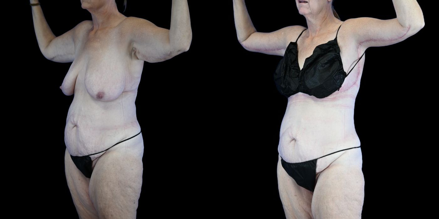 Before and after Body Lift case 26085 - Angle 2