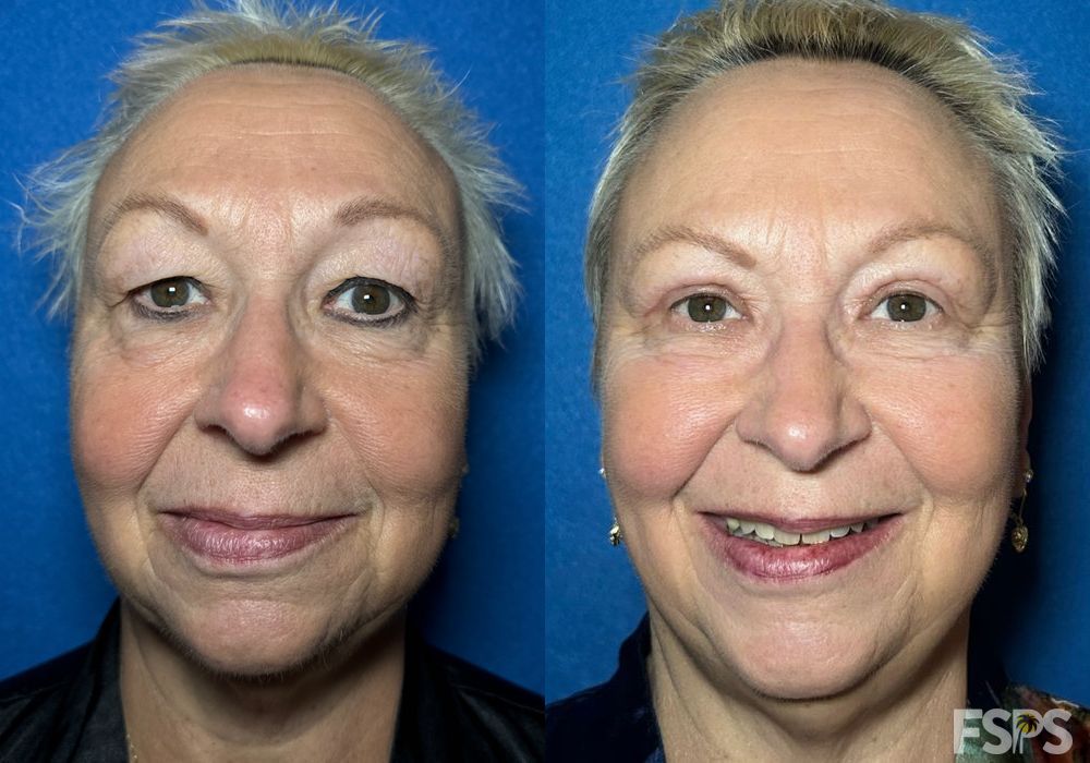 Blepharoplasty - Case 22972
