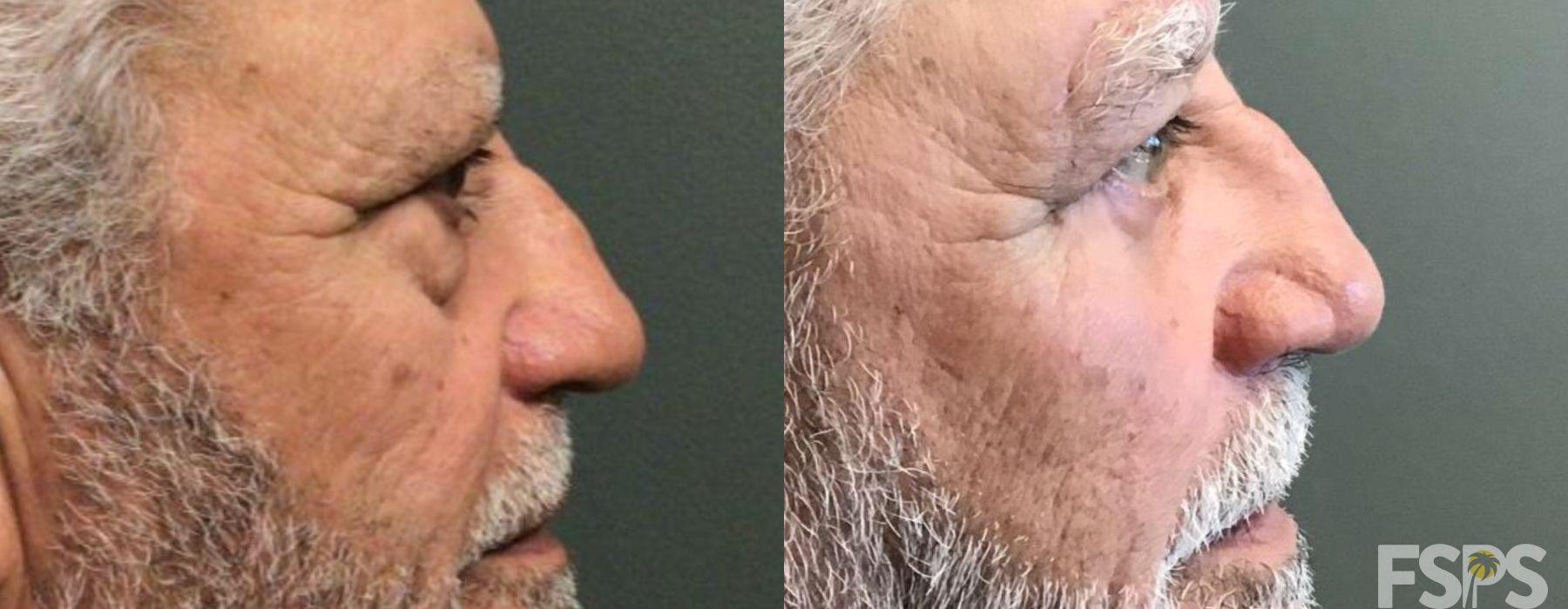 Brow Lift - Thumbnail 2