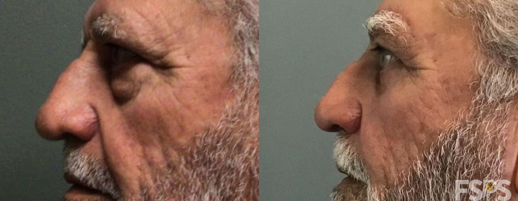 Brow Lift - Case 22819