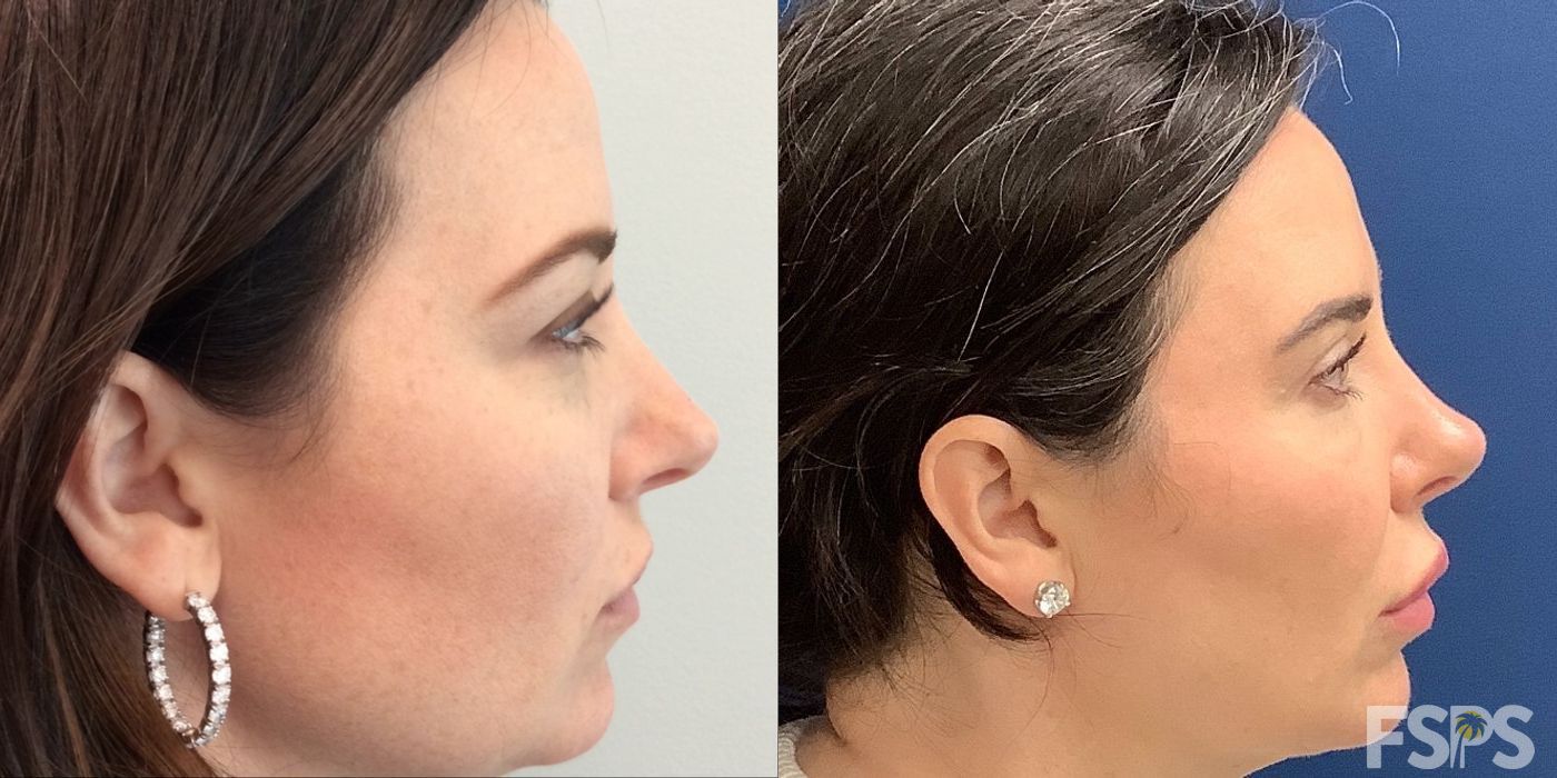 Blepharoplasty - Thumbnail 2