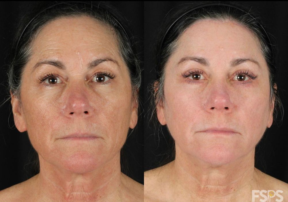Blepharoplasty - Case 22685