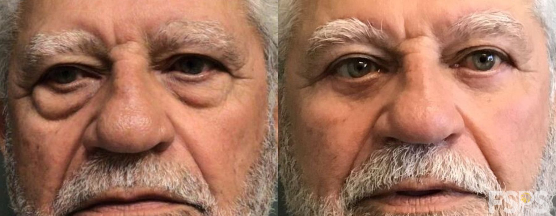 Before and after Brow Lift case 17655 - Angle 3