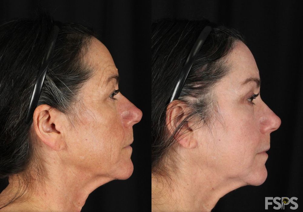 Peels & Facials - Thumbnail 3