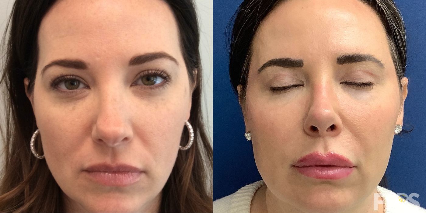 Blepharoplasty - Thumbnail 3