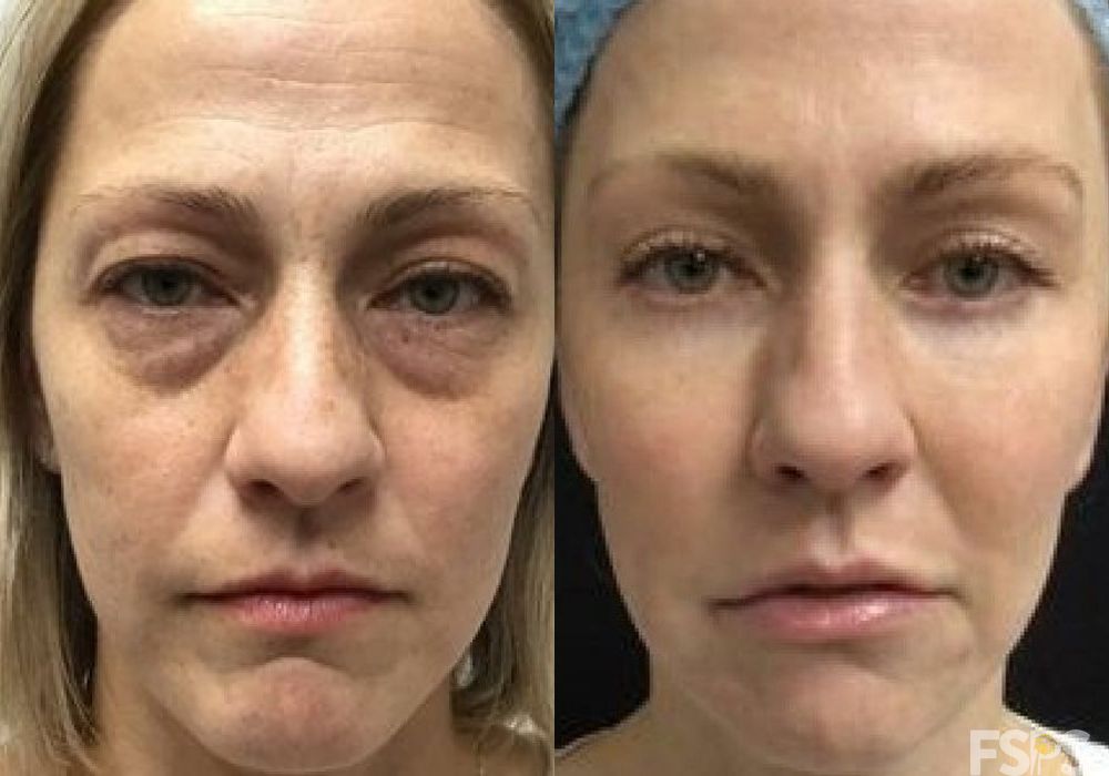 Mid Facelift - Case 22826