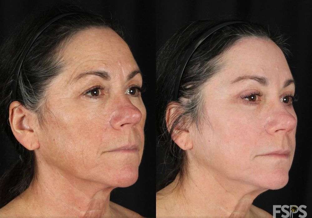 Blepharoplasty - Thumbnail 2