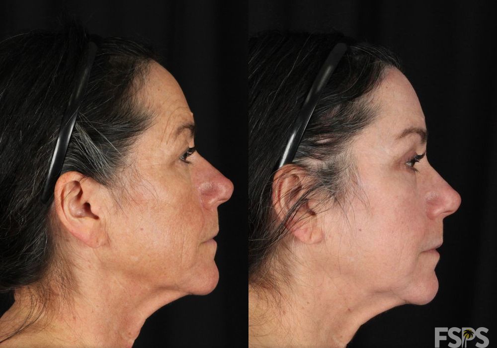 Blepharoplasty - Thumbnail 3