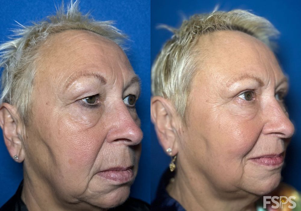 Blepharoplasty - Thumbnail 2