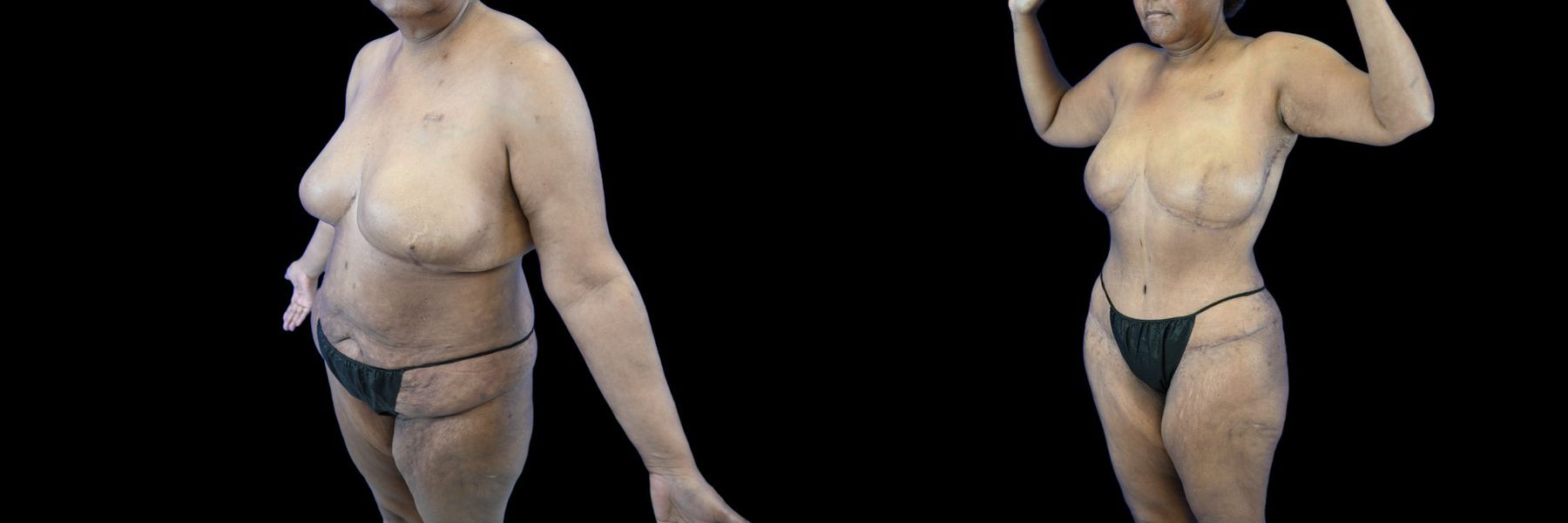 Before and after Mommy Makeover case 26081 - Angle 2