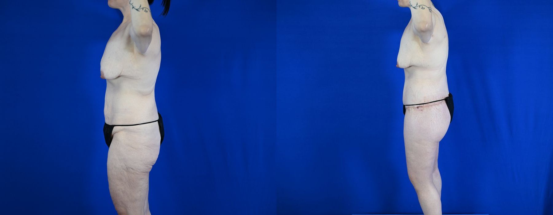 Tummy Tuck - Thumbnail 3