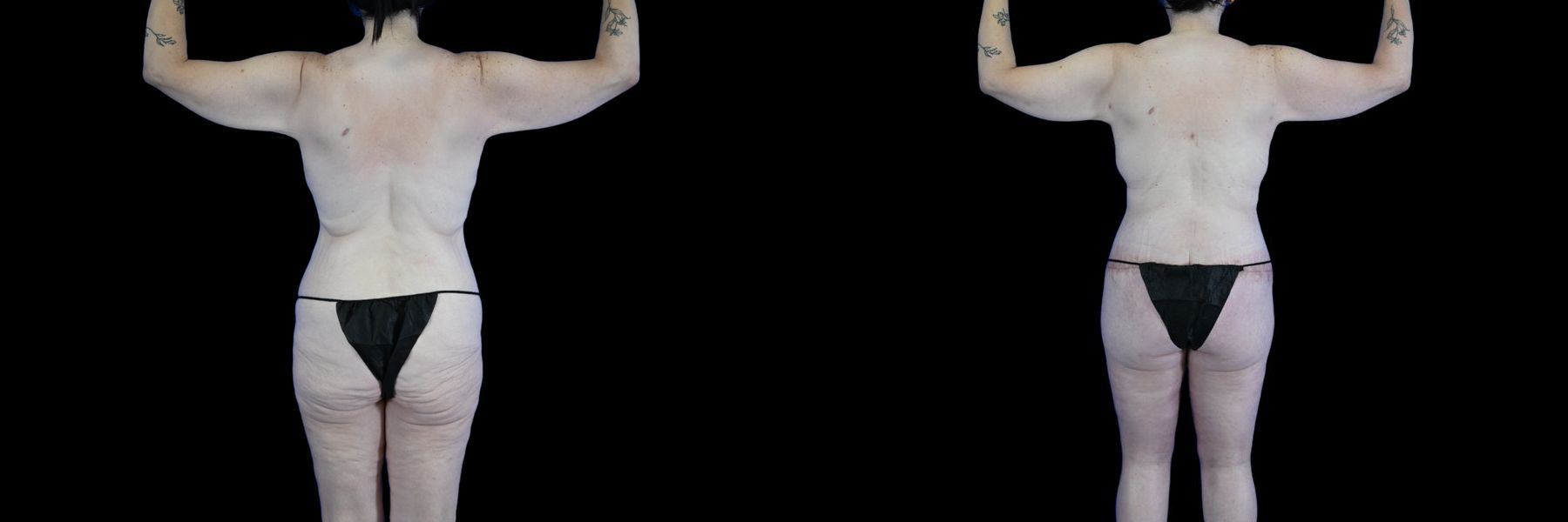 Before and after Body Lift case 26079 - Angle 4