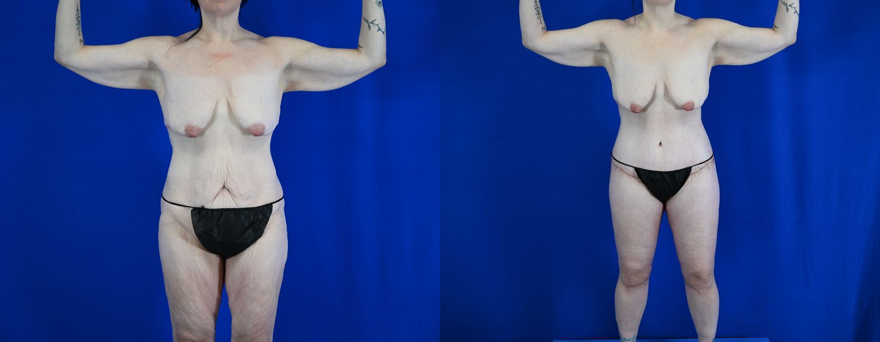 Tummy Tuck - Case 22933