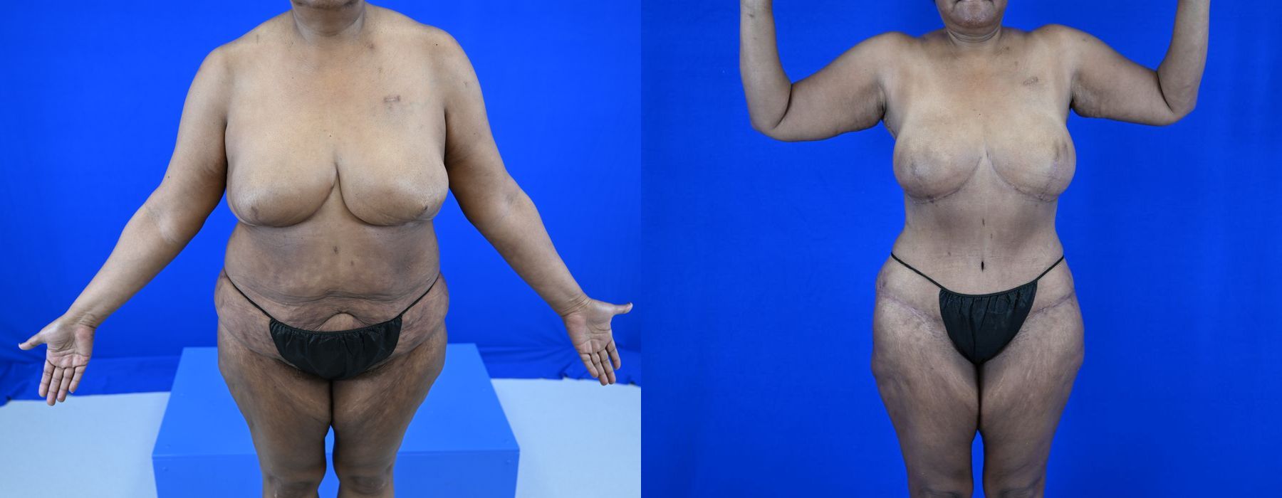 Implant Exchange - Case 22970