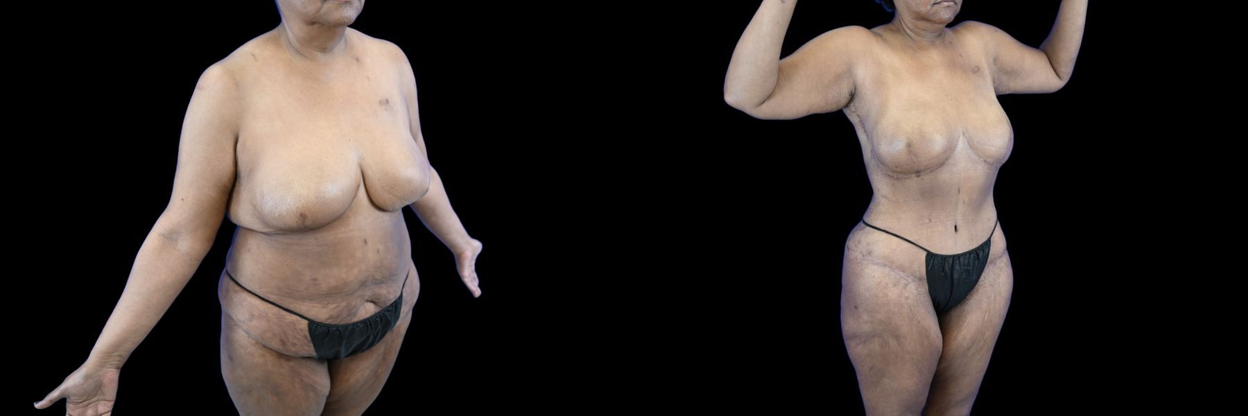 Before and after Mommy Makeover case 26081 - Angle 3