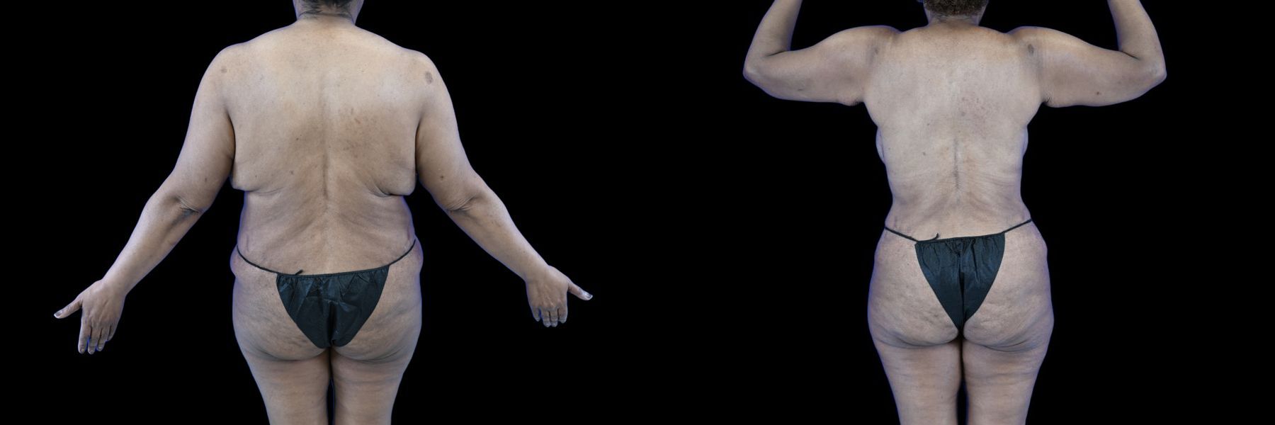 Before and after Mommy Makeover case 26081 - Angle 4