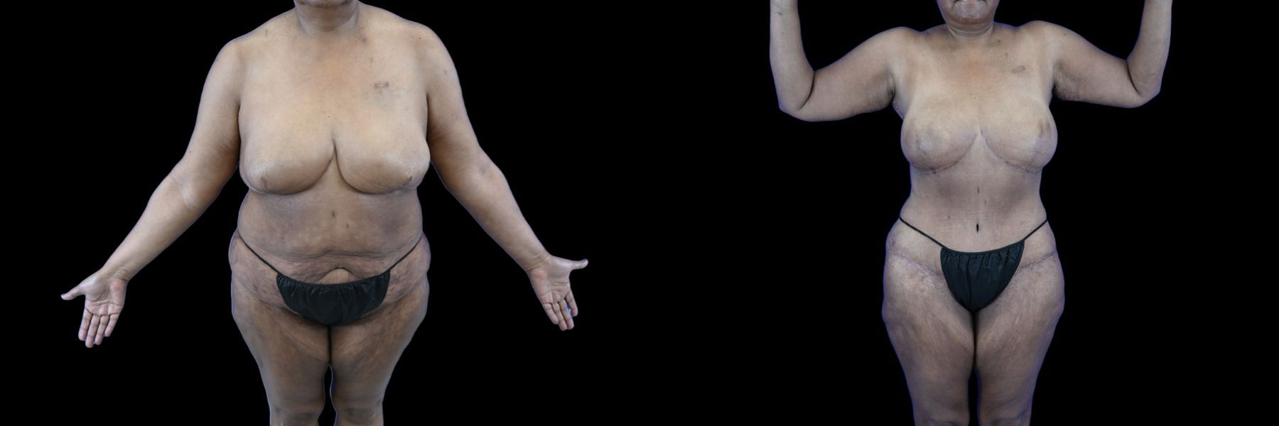 Before and after Mommy Makeover case 26081