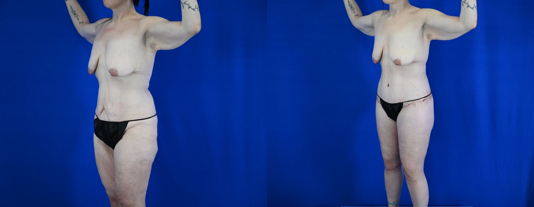 Tummy Tuck - Thumbnail 2