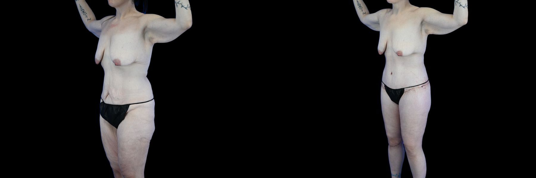 Before and after Body Lift case 26079 - Angle 2