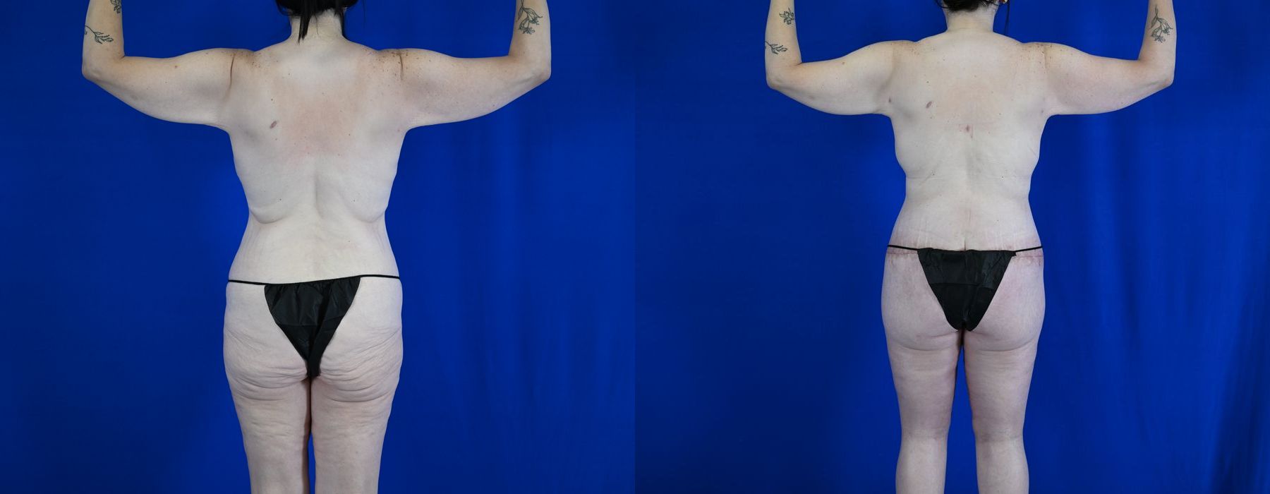 Tummy Tuck - Thumbnail 4