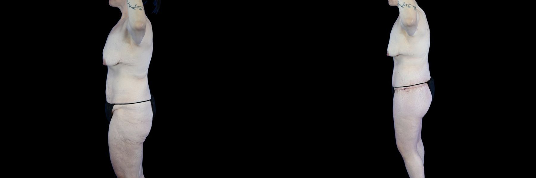 Before and after Body Lift case 26079 - Angle 3