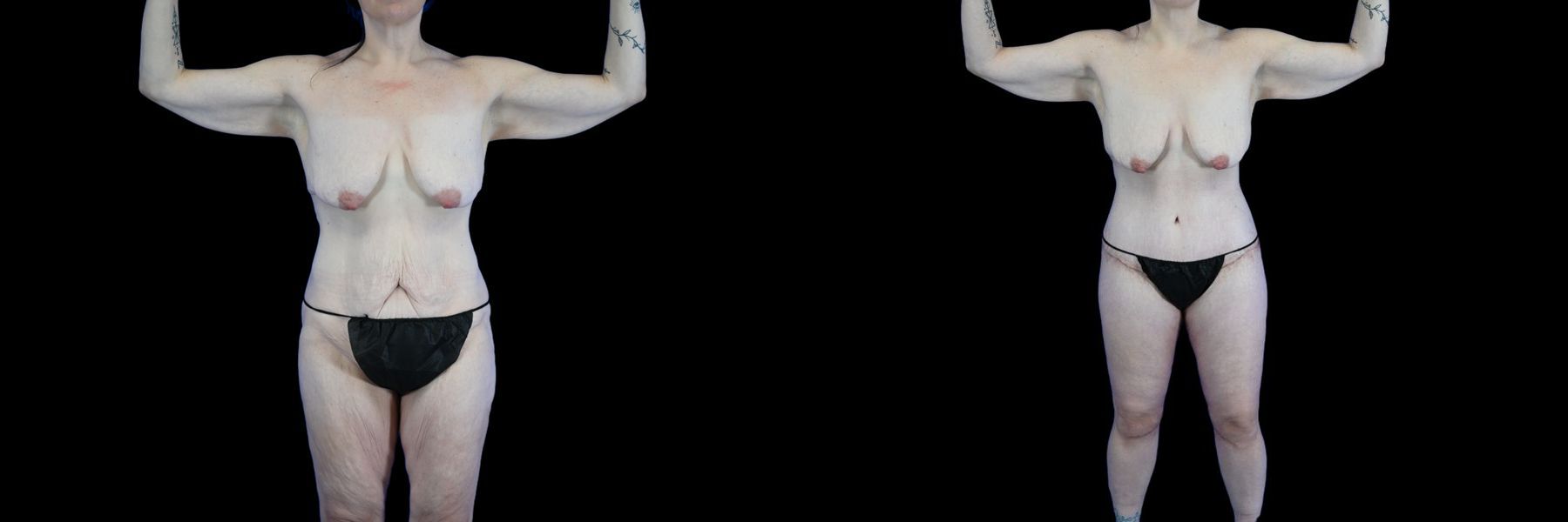 Before and after Body Lift case 26079